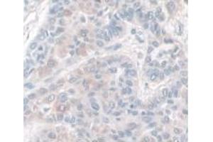 IHC-P analysis of Human Liver Cancer Tissue, with DAB staining. (HPR anticorps  (AA 70-332))