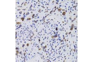 Immunohistochemistry of paraffin-embedded human gastric cancer using HDGF Antibody. (HDGF anticorps  (AA 1-240))