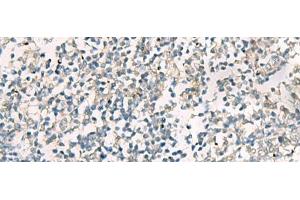Immunohistochemistry of paraffin-embedded Human tonsil tissue using SERPINB4 Polyclonal Antibody at dilution of 1:40(x200) (SERPINB4 anticorps)
