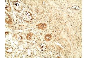 Immunohistochemistry analysis of human colon tumor tissue using Glucagon like peptide 1 pAb,  at a dilution of 1:500. (GLP-1 anticorps  (AA 1-19))