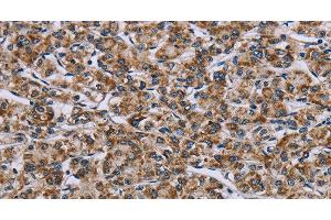 Immunohistochemistry of paraffin-embedded Human prostate cancer tissue using GTPBP10 Polyclonal Antibody at dilution 1:60 (GTPBP10 anticorps)
