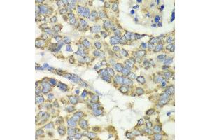 Immunohistochemistry of paraffin-embedded human esophageal cancer using TUFM antibody at dilution of 1:100 (x40 lens). (TUFM anticorps)