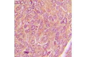 Immunohistochemical analysis of AKAP1 staining in human breast cancer formalin fixed paraffin embedded tissue section. (AKAP1 anticorps)