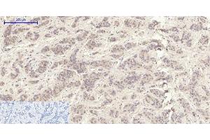 Immunohistochemistry of paraffin-embedded Human liver cancer tissue using MMP2 Polyclonal Antibody at dilution of 1:200.