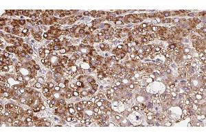 ABIN6279843 at 1/100 staining Human liver cancer tissue by IHC-P.