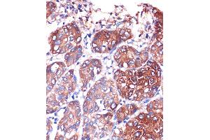 Immunohistochemistry of paraffin-embedded Human liver cancer using LYPL Rabbit pAb (ABIN1680728, ABIN3018907, ABIN3018908 and ABIN6220622) at dilution of 1:100 (40x lens). (LYPLA1 anticorps  (AA 1-230))