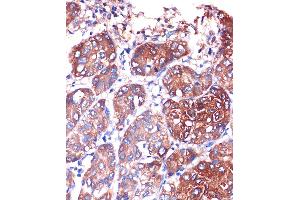 Immunohistochemistry of paraffin-embedded Human liver cancer using LYPL Rabbit pAb (ABIN1680728, ABIN3018907, ABIN3018908 and ABIN6220622) at dilution of 1:100 (40x lens). (LYPLA1 anticorps  (AA 1-230))