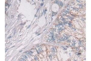 Detection of OAT in Human Colorectal cancer Tissue using Polyclonal Antibody to Ornithine Aminotransferase (OAT)