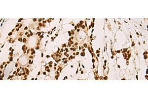 Immunohistochemistry of paraffin-embedded Human colorectal cancer tissue using ELF5 Polyclonal Antibody at dilution of 1:70(x200) (ELF5 anticorps)