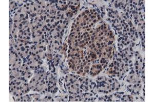 Immunohistochemical staining of paraffin-embedded Carcinoma of Human lung tissue using anti-BTN1A1 mouse monoclonal antibody. (BTN1A1 anticorps)