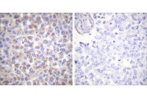 Peptide - +Immunohistochemical analysis of paraffin-embedded human breast carcinoma tissue using 14-3-3 ζ (Ab-58) antibody (#B0001). (14-3-3 zeta anticorps  (Ser58))