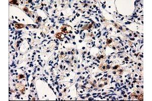 Immunohistochemical staining of paraffin-embedded Carcinoma of Human kidney tissue using anti-PRPSAP2 mouse monoclonal antibody. (PRPSAP2 anticorps)