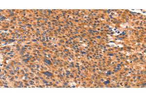 Immunohistochemistry of paraffin-embedded Human liver cancer using AMPD1 Polyclonal Antibody at dilution of 1:80 (AMPD1 anticorps)