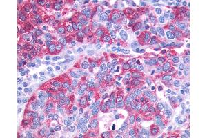 Anti-GPR143 antibody IHC of human Ovary, Carcinoma. (GPR143 anticorps  (C-Term))