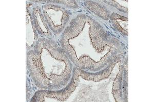 Immunohistochemical staining (Formalin-fixed paraffin-embedded sections) of human prostate cancer with OCLN monoclonal antibody, clone CL1555  shows membranous positivity in tumor cells. (Occludin anticorps  (AA 282-415))