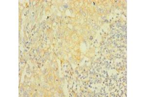 Immunohistochemistry of paraffin-embedded human lung cancer using ABIN7167028 at dilution of 1:100