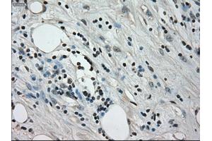 Immunohistochemical staining of paraffin-embedded Adenocarcinoma of colon tissue using anti-CRYABmouse monoclonal antibody. (CRYAB anticorps)