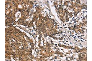 The image on the left is immunohistochemistry of paraffin-embedded Human gastic cancer tissue using ABIN7190329(COL7A1 Antibody) at dilution 1/25, on the right is treated with synthetic peptide. (COL7A1 anticorps)