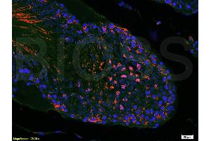 Formalin-fixed and paraffin embedded mouse melanoma tissue labeled with Anti-mTOR Polyclonal Antibody, Unconjugated (ABIN676403) at 1:200 followed by conjugation to the secondary antibody and DAB staining