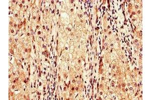 Immunohistochemistry of paraffin-embedded human liver cancer using ABIN7147989 at dilution of 1:100