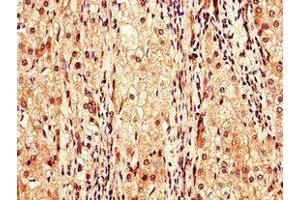 Immunohistochemistry of paraffin-embedded human liver cancer using ABIN7147989 at dilution of 1:100 (Coagulation Factor IX anticorps  (AA 144-239))