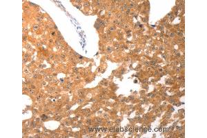Immunohistochemistry of Human breast cancer using PARP1 Polyclonal Antibody at dilution of 1:25 (PARP1 anticorps)
