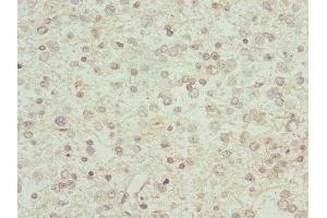 Immunohistochemistry of paraffin-embedded human glioma using ABIN7156561 at dilution of 1:100