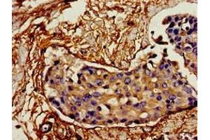 Immunohistochemistry of paraffin-embedded human breast cancer using ABIN7156781 at dilution of 1:100