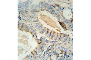 Immunohistochemistry analysis in formalin fixed and paraffin embedded human prostate carcinoma reacted with GCNT2 /  NACGT1 Antibody (C-term) followed by peroxidase conjugation of the secondary antibody and DAB staining.
