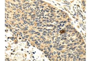 The image on the left is immunohistochemistry of paraffin-embedded Human esophagus cancer tissue using ABIN7131002(SEMA4F Antibody) at dilution 1/35, on the right is treated with fusion protein. (SEMA4F anticorps)