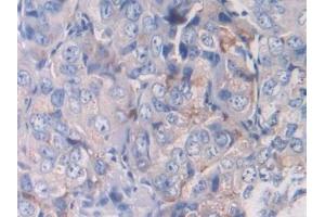 Detection of HIF1a in Human Breast cancer Tissue using Polyclonal Antibody to Hypoxia Inducible Factor 1 Alpha (HIF1a)