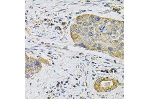 Immunohistochemistry of paraffin-embedded human lung cancer using KRT20 Antibody. (KRT20 anticorps  (AA 245-424))