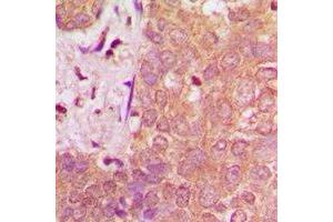 Immunohistochemical analysis of NAV1 staining in human breast cancer formalin fixed paraffin embedded tissue section. (NAV1 anticorps)