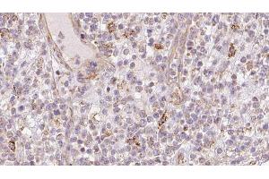 ABIN6273211 at 1/100 staining Human lymph cancer tissue by IHC-P. (CNPY2/MSAP anticorps  (C-Term))