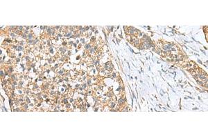 Immunohistochemistry of paraffin-embedded Human esophagus cancer tissue using CEMIP Polyclonal Antibody at dilution of 1:120(x200) (CEMIP anticorps)