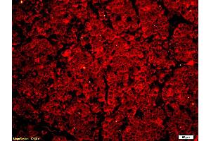 Formalin-fixed and paraffin embedded human lung carcinoma labeled with Anti Phospho-MLK3 (Thr277/Ser281) Polyclonal Antibody, Unconjugated at 1:200 followed by conjugation to the secondary antibody Goat Anti-Rabbit IgG, Cy3 conjugated used at 1:200 dilution for 40 minutes at 37°C.