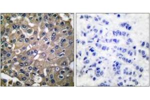 Immunohistochemistry analysis of paraffin-embedded human breast carcinoma tissue, using MMP-9 Antibody. (MMP 9 anticorps  (AA 651-700))