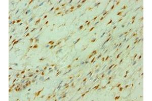 Immunohistochemistry of paraffin-embedded human breast cancer using ABIN7147792 at dilution of 1:100 (CLOCK anticorps  (AA 577-846))