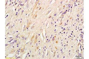 Formalin-fixed and paraffin embedded human lung inflammation labeled with Rabbit Anti IRS-3 Polyclonal Antibody, Unconjugated (ABIN726005) at 1:200 followed by conjugation to the secondary antibody and DAB staining (IRS3 anticorps  (AA 261-360))