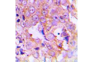 Immunohistochemical analysis of EEF2 (pT56) staining in human lung cancer formalin fixed paraffin embedded tissue section.