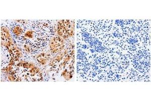 The image on the left is immunohistochemistry of paraffin-embedded Human lung cancer tissue using 31024 (AAK1 Antibody) at dilution 1/30, on the right is treated with the fusion protein.