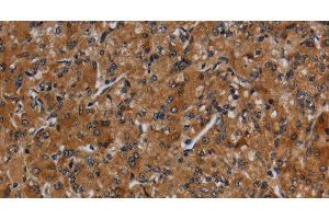 Immunohistochemistry of paraffin-embedded Human prostate cancer using CYP1A2 Polyclonal Antibody at dilution of 1:40 (CYP1A2 anticorps)