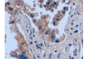 Detection of CD7 in Human Lung cancer Tissue using Polyclonal Antibody to Cluster Of Differentiation 7 (CD7)