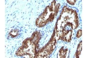 IHC testing of FFPE human prostate carcinoma with TDP2 antibody (clone TDP2/1258). (TDP2 anticorps)