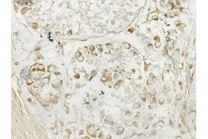 ABIN6262558 and ABIN6277619 at 1/100 staining human gastric carcinoma by IHC-P. (IL-27 anticorps  (Internal Region))