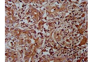 IHC image of ABIN7165027 diluted at 1:400 and staining in paraffin-embedded human liver cancer performed on a Leica BondTM system. (AHNAK2 anticorps  (AA 195-349))
