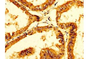 IHC image of ABIN7156276 diluted at 1:200 and staining in paraffin-embedded human endometrial cancer performed on a Leica BondTM system.