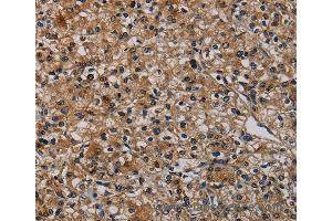 Immunohistochemistry of Human prostate cancer using TP53INP1 Polyclonal Antibody at dilution of 1:50 (TP53INP1 anticorps)