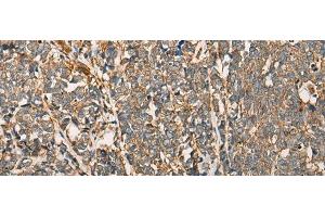 Immunohistochemistry of paraffin-embedded Human lung cancer tissue using MYL12B Polyclonal Antibody at dilution of 1:25(x200)