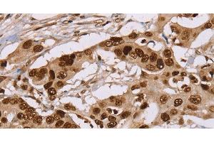 Immunohistochemistry of paraffin-embedded Human colon cancer using NUP50 Polyclonal Antibody at dilution of 1:30 (NUP50 anticorps)